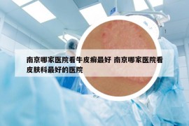 南京哪家醫(yī)院看牛皮癬最好 南京哪家醫(yī)院看皮膚科最好的醫(yī)院