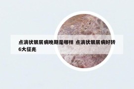 點滴狀銀屑病晚期是哪樣 點滴狀銀屑病好轉(zhuǎn)6大征兆