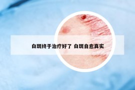 白斑終于治療好了 白斑自愈真實
