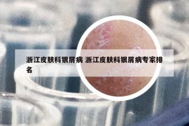 浙江皮膚科銀屑病 浙江皮膚科銀屑病專家排名