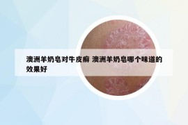 澳洲羊奶皂對牛皮癬 澳洲羊奶皂哪個味道的效果好