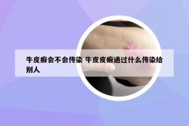 牛皮癬會(huì)不會(huì)傳染 牛皮皮癬通過(guò)什么傳染給別人