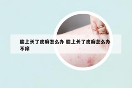 臉上長了皮癬怎么辦 臉上長了皮癬怎么辦 不癢
