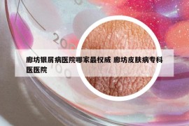 廊坊銀屑病醫(yī)院哪家最權(quán)威 廊坊皮膚病?？漆t(yī)醫(yī)院