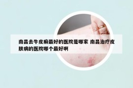 南昌去牛皮癬最好的醫(yī)院是哪家 南昌治療皮膚病的醫(yī)院哪個最好啊