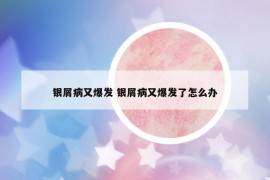 銀屑病又爆發(fā) 銀屑病又爆發(fā)了怎么辦