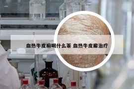 血熱牛皮癬喝什么茶 血熱牛皮廨治療