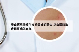 華山醫(yī)院治療牛皮癬最好的醫(yī)生 華山醫(yī)院治療銀屑病怎么樣