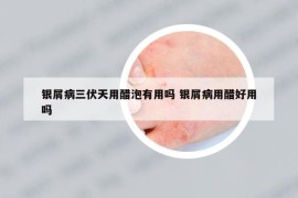 銀屑病三伏天用醋泡有用嗎 銀屑病用醋好用嗎