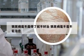 銀屑病是不是得了就不好治 銀屑病是不是不能治愈