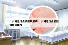 什么叫急性點(diǎn)滴型銀屑病 什么叫急性點(diǎn)滴型銀屑病圖片