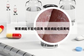 銀屑病能不能吃蒜黃 銀屑病能吃蒜黃嗎
