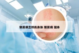 銀屑病怎樣練身體 銀屑病 健身