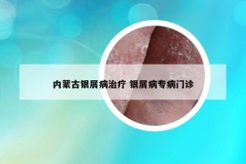 內(nèi)蒙古銀屑病治療 銀屑病專病門診