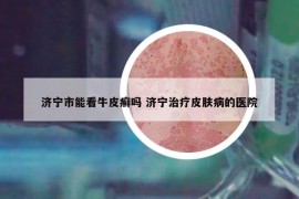 濟(jì)寧市能看牛皮癬嗎 濟(jì)寧治療皮膚病的醫(yī)院