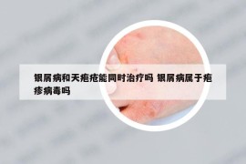 銀屑病和天皰瘡能同時治療嗎 銀屑病屬于皰疹病毒嗎