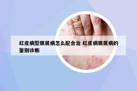紅皮病型銀屑病怎么配合治 紅皮病銀屑病的鑒別診斷
