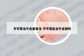 節(jié)節(jié)草治牛皮癬用法 節(jié)節(jié)草能治牛皮鮮嗎