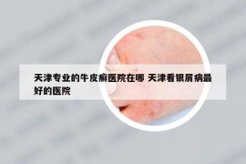 天津?qū)I(yè)的牛皮癬醫(yī)院在哪 天津看銀屑病最好的醫(yī)院