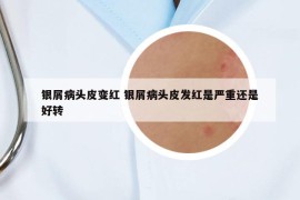 銀屑病頭皮變紅 銀屑病頭皮發(fā)紅是嚴(yán)重還是好轉(zhuǎn)