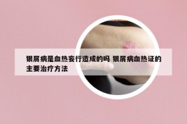 銀屑病是血熱妄行造成的嗎 銀屑病血熱證的主要治療方法
