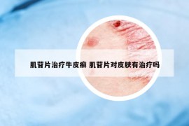 肌苷片治療牛皮癬 肌苷片對皮膚有治療嗎