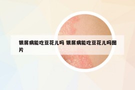 銀屑病能吃豆花兒?jiǎn)?銀屑病能吃豆花兒?jiǎn)釄D片