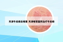 天津牛皮癬去哪里 天津哪家醫(yī)院治療牛皮癬