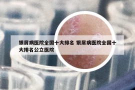 銀屑病醫(yī)院全國十大排名 銀屑病醫(yī)院全國十大排名公立醫(yī)院