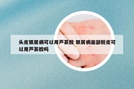 頭皮銀屑病可以用蘆薈膠 銀屑病面部脫皮可以用蘆薈膠嗎