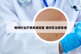 楮樹葉治療銀屑病用量 楮樹漿治銀屑病