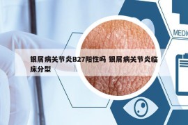銀屑病關(guān)節(jié)炎B27陽(yáng)性嗎 銀屑病關(guān)節(jié)炎臨床分型