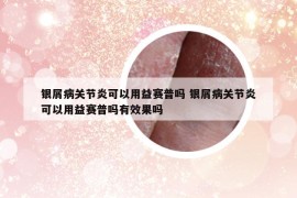 銀屑病關(guān)節(jié)炎可以用益賽普嗎 銀屑病關(guān)節(jié)炎可以用益賽普嗎有效果嗎