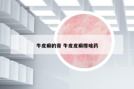 牛皮癬的膏 牛皮皮癬擦啥藥