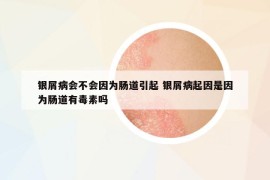 銀屑病會不會因?yàn)槟c道引起 銀屑病起因是因?yàn)槟c道有毒素嗎