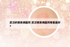 武漢的銀屑病醫(yī)院 武漢銀屑病醫(yī)院哪里最好?