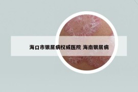 ?？谑秀y屑病權(quán)威醫(yī)院 海南銀屑病
