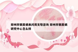鄭州市銀屑病來問周文敬咨詢 鄭州市銀屑病研究中心怎么樣