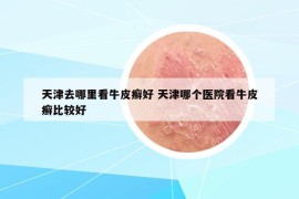 天津去哪里看牛皮癬好 天津哪個醫(yī)院看牛皮癬比較好