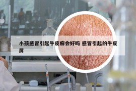小孩感冒引起牛皮癬會(huì)好嗎 感冒引起的牛皮屑