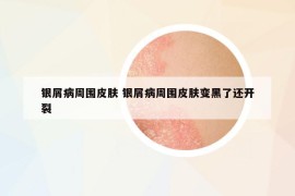 銀屑病周圍皮膚 銀屑病周圍皮膚變黑了還開(kāi)裂