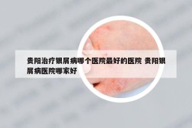 貴陽治療銀屑病哪個醫(yī)院最好的醫(yī)院 貴陽銀屑病醫(yī)院哪家好