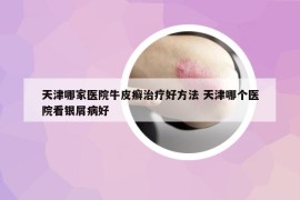 天津哪家醫(yī)院牛皮癬治療好方法 天津哪個醫(yī)院看銀屑病好