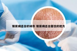 銀屑病適合的城市 銀屑病適合居住的地方