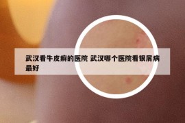 武漢看牛皮癬的醫(yī)院 武漢哪個(gè)醫(yī)院看銀屑病最好