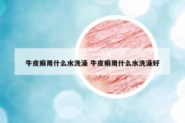 牛皮癬用什么水洗澡 牛皮癬用什么水洗澡好