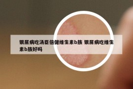 銀屑病吃湯臣倍健維生素b族 銀屑病吃維生素b族好嗎