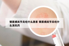 銀屑病關(guān)節(jié)炎吃什么激素 銀屑病關(guān)節(jié)炎吃什么消炎藥
