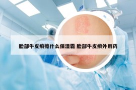 臉部牛皮癬擦什么保濕霜 臉部牛皮癬外用藥