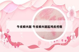 牛皮癬大腿 牛皮癬大腿起雞皮疙瘩